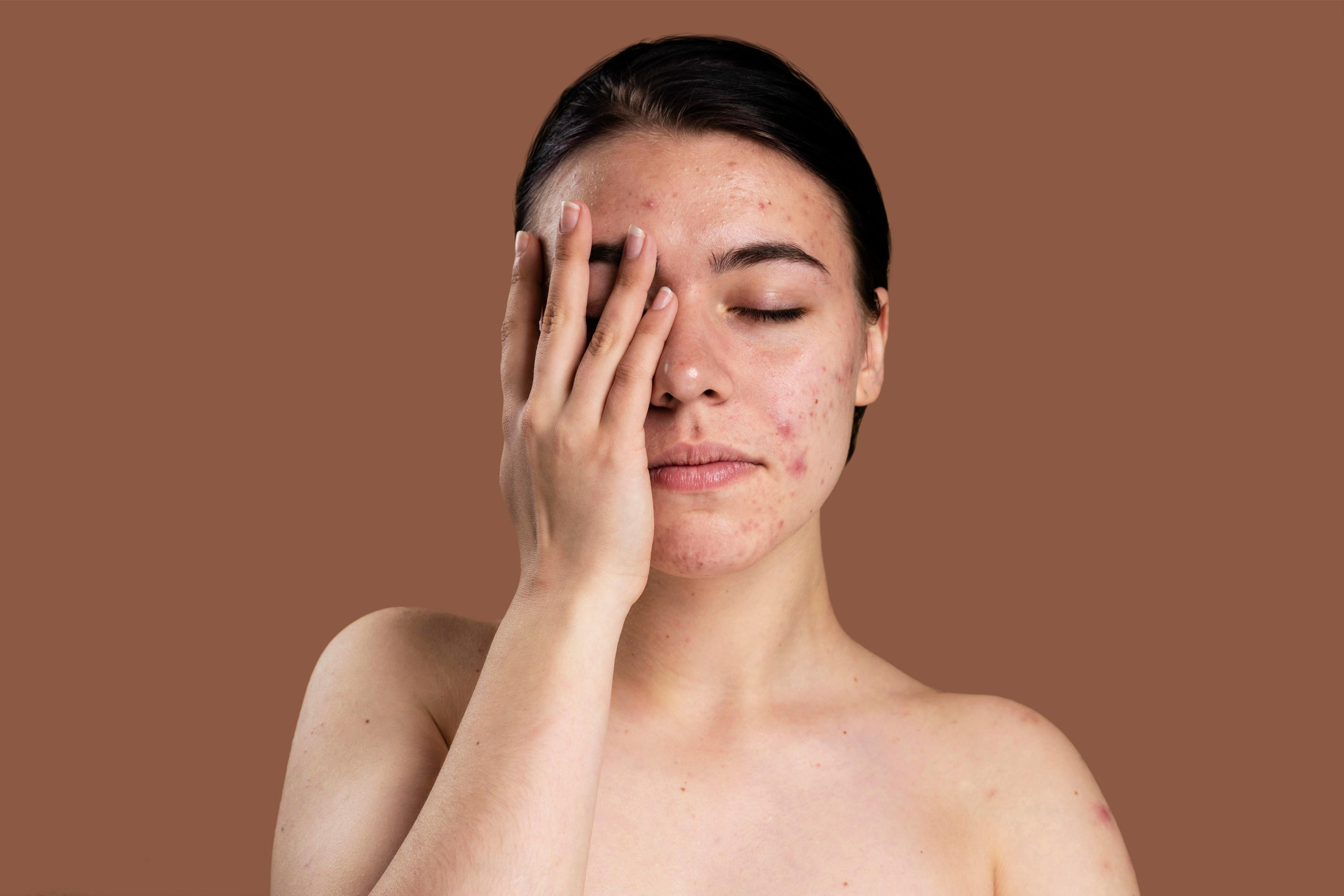 Best Dermatologists in Vizag for Acne and Scar Treatment